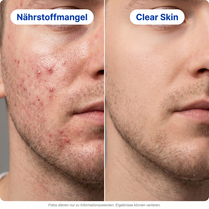 Clear™ Skin Support